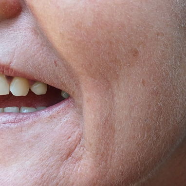 Prótesis Dental parciales y totales removible de acrílico - Img 125960864