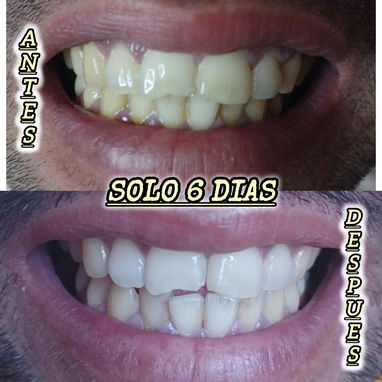 Pasta de dientes blanqueadora - Img 118180261
