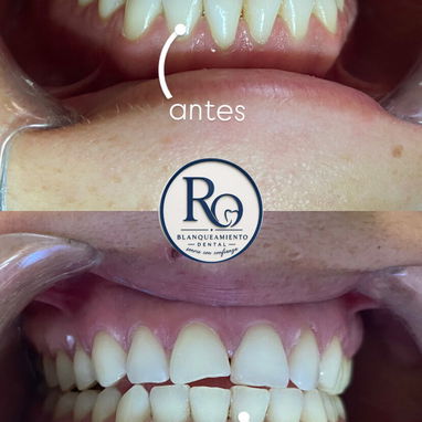 Limpiezas y Blanqueamientos Dentales - Img 127766416