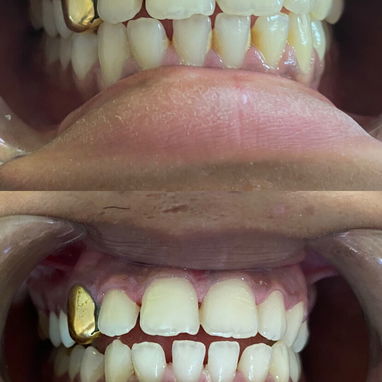Limpiezas y Blanqueamientos dentales - 3/5