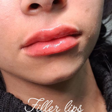 💉 Descubre el poder de la técnica de 4 puntos con ácido hialurónico y el aumento de labios en Spa Leydis. 🌸 - Img 122760912