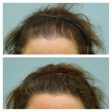 Minoxidil 5% caída de cabello recuperar el pelo alopecia calvicie - Img 117739100