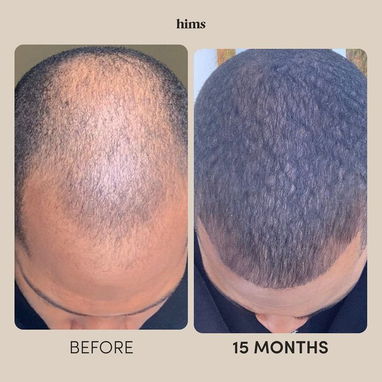 Minoxidil 5% caída de cabello recuperar el pelo alopecia calvicie - Img 117739099