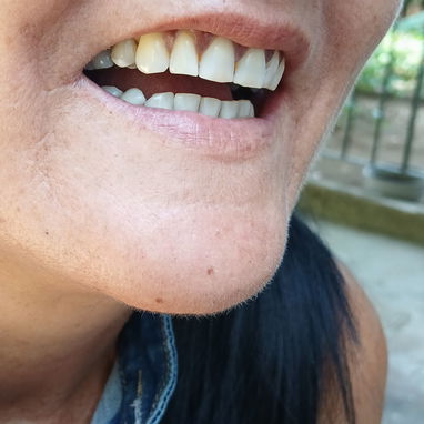 Prótesis Dental parciales y totales removible de acrílico - Img 125960850