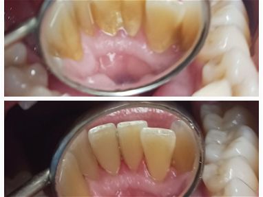 Limpiezas y blanqueamientos dentales realizadas por profesionales,le ayudamos a mejorar su sonrisa - Img 68682858