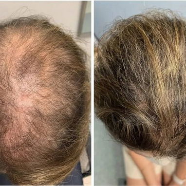Minoxidil 5% caída de cabello recuperar el pelo alopecia calvicie - Img 117739102