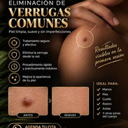 Eliminación de verrugas comunes - Img 57690556