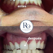 Limpiezas y Blanqueamientos Dentales - Img 56789828