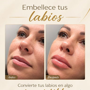 AUMENTO DE LABIOS EN SPA LEYDIS MARIANAO - 2/9