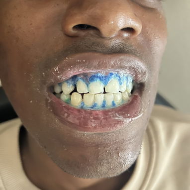 Blanqueamiento y limpieza dental - Img 127131691