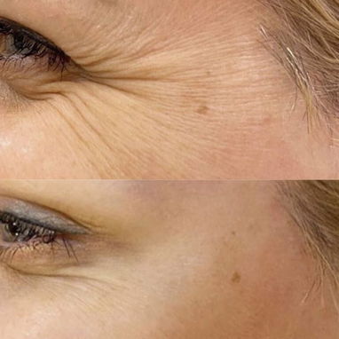 Aplicación de Botox - 2/3