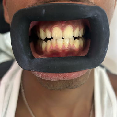 Blanqueamiento dental - Img 125489608