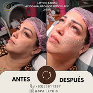 💉 Descubre el poder de la técnica de 4 puntos con ácido hialurónico y el aumento de labios en Spa Leydis. 🌸 - Img 55673793