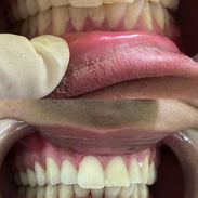 Limpiezas y blanqueamientos dentales - Img 57811853