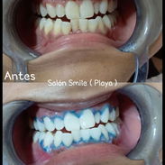 Blanqueamiento y limpieza dental - Img 56644524