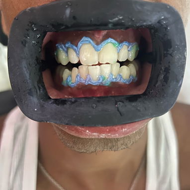 Blanqueamiento y limpieza dental - Img 127131669