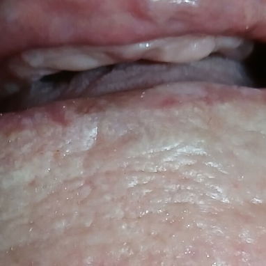 Prótesis Dental parciales y totales removible de acrílico - Img 125960899