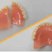 CONFECCION Y REPARACION DE PRÓTESIS DENTALES ACRÍLICAS  😁 - Img 44625227