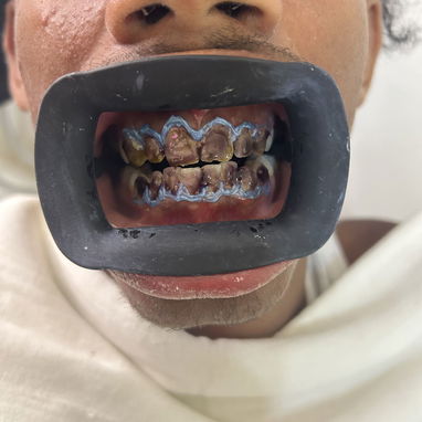 Blanqueamiento dental - Img 125489609