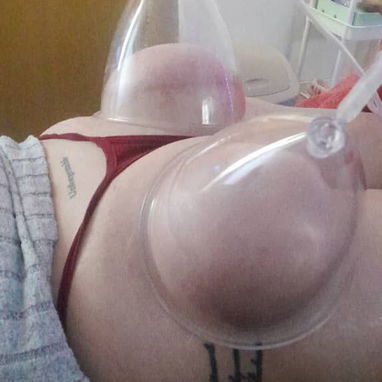 Paquete de glúteos. Radiofrecuencia, Vacunterapia y ondas rusas - 2/3