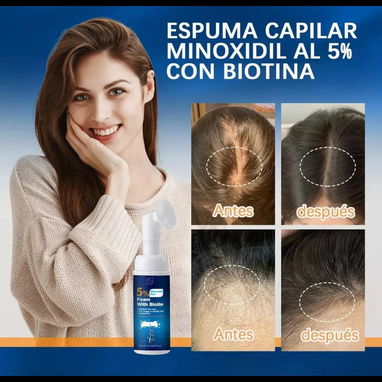 Minoxidil para prevenir la caída del cabello, estimula el crecimiento. - Img 121391731