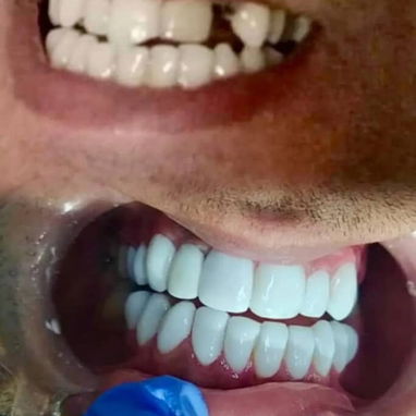 Diseño d sonrisa - 8/10