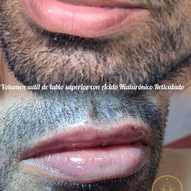💉 Descubre el poder de la técnica de 4 puntos con ácido hialurónico y el aumento de labios en Spa Leydis Marianao 🌸 - Img 121800195