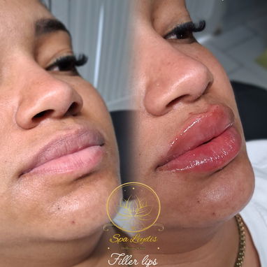 🚨 ¡LLEGÓ TU MOMENTO DE LUCIR LA SONRISA QUE MERECES! ¿Labios más llenos, definidos y súper hidratados? - Img 127434653