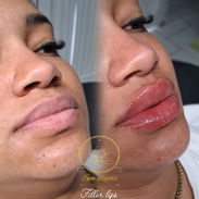 Aumento de labios con ácido hialurónico en Spa_leydis🪷 Marianao. Resalta su belleza de forma natural - Img 56846095