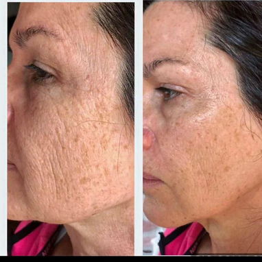 ⚡Botox instantáneo ⚡ - Img 124439408