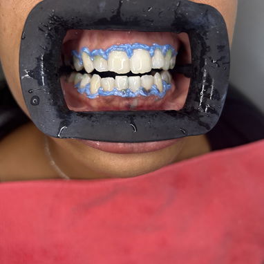 Blanqueamiento y limpieza dental - Img 122385400