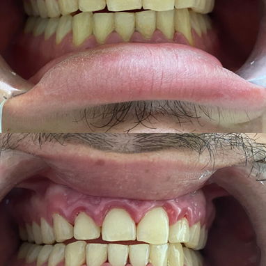 Limpiezas y blanqueamientos dentales - 2/4