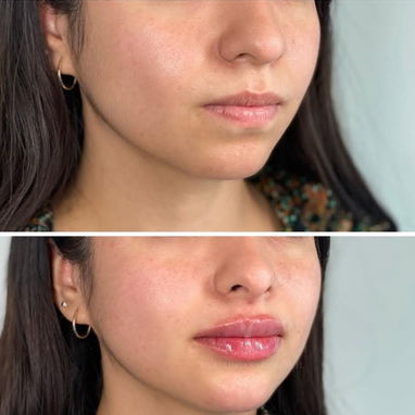 Aumento y definición de labios con Ácido Hialurónico - 2/2