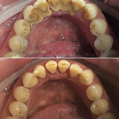 Blanqueamiento y limpieza dental - Img 127130234