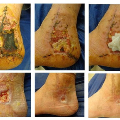Apósitos de hidrogel para heridas contaminadas, úlceras y Quemaduras - 4/4