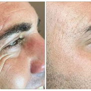 Aplicación de Botox - Img 57554822