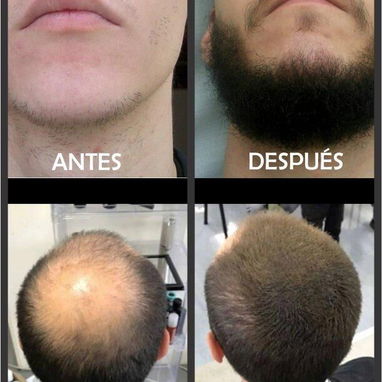 Tratamiento Minoxidil Kirkland al 5% Para 1 año - Img 117814336