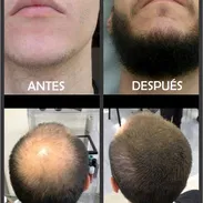 Minoxidil - Img 45939796