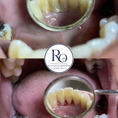 Limpiezas y blanqueamientos dentales - Img 122088742