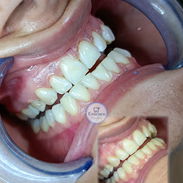 Limpiezas y Blanqueamientos Dentales - Img 56746913