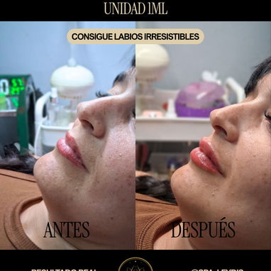 Aumento de labios con ácido hialurónico en Spa_leydis🪷 Marianao - Img 127810054