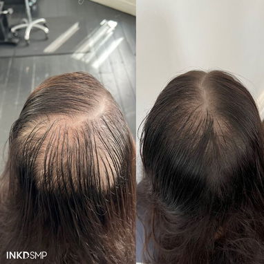 Minoxidil 5% caída de cabello recuperar el pelo alopecia calvicie - Img 117739101