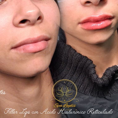 💉 Descubre el poder de la técnica de 4 puntos con ácido hialurónico y el aumento de labios en Spa Leydis Marianao 🌸 - Img 121800211