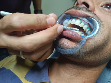 Limpieza dental profunda y blanqueamiento dental - Img main-image