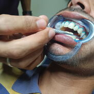 Limpieza dental profunda y blanqueamiento dental - Img 45363289