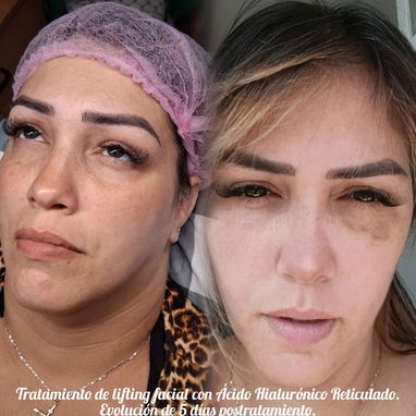 💉 Descubre el poder de la técnica de 4 puntos con ácido hialurónico y el aumento de labios en Spa Leydis Marianao 🌸 - Img 121800196