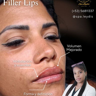 💉 Descubre el poder de la técnica de 4 puntos con ácido hialurónico y el aumento de labios en Spa Leydis. 🌸 - Img 122760906