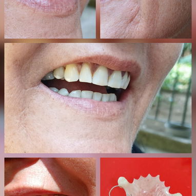 Prótesis Dental parciales y totales removible de acrílico - Img 122724533
