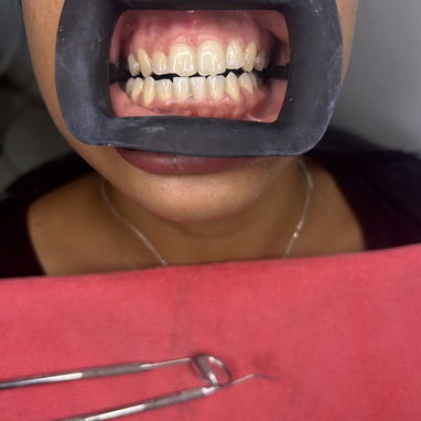 Blanqueamiento y limpieza dental - Img 127131680