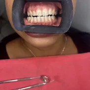 Blanqueamiento y limpieza dental - Img 55596940
